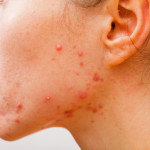 How to get rid of cystic acne