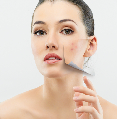 Best DIY Face Masks For Acne | Acne Treatments