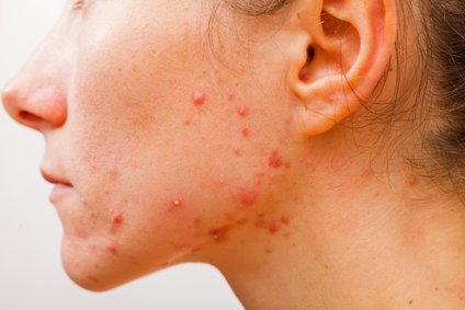How To Get Rid Of Cystic Acne Fast