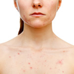 How Do You Get Rid Of Chest Acne And Pimples