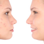 Side Effects Of Over The Counter Acne Products