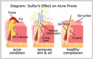 Over The Counter Sulfur Treatments For Acne And Their Side Effects