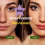 Best Face Cream For Acne